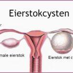 Wat zijn eierstokcysten?