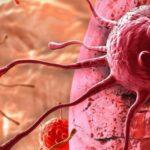 Nieuwe behandeling voor patiënten met vulvakanker in aantocht